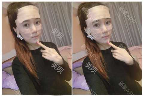 在北京市炫美医疗美容做的自体脂肪填充