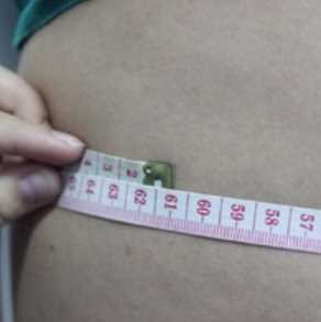 ¥35200做的大腿吸脂在成都艾米