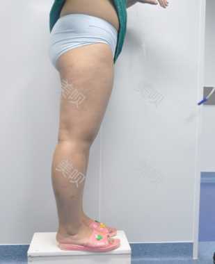 ¥35200做的大腿吸脂在成都艾米