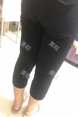 ¥35200做的大腿吸脂在成都艾米