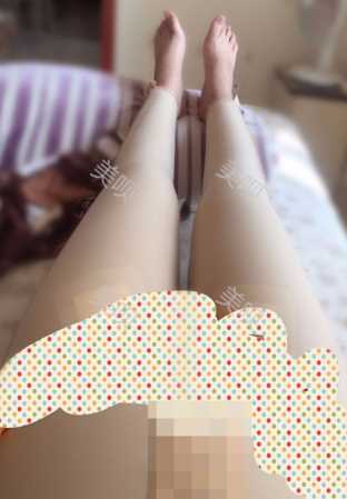¥35200做的大腿吸脂在成都艾米