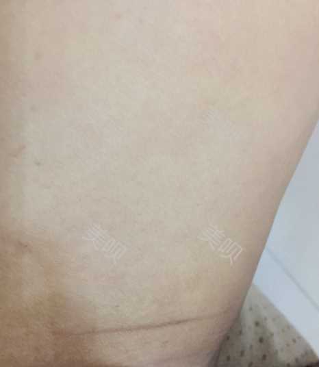¥35200做的大腿吸脂在成都艾米