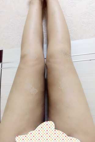 ¥35200做的大腿吸脂在成都艾米