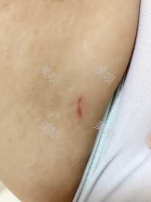 ¥35200做的大腿吸脂在成都艾米