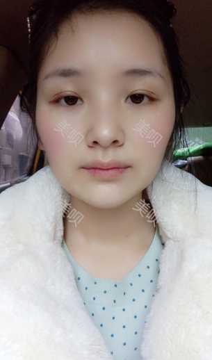 ¥3800双眼皮长沙美之峰