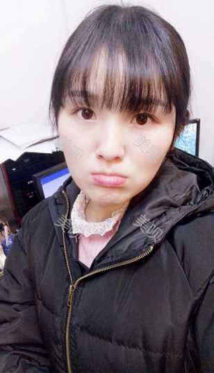 ¥3800双眼皮长沙美之峰