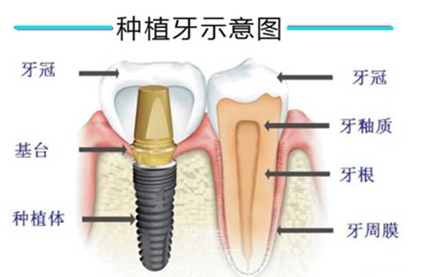 牙种植体与陶瓷牙的区别