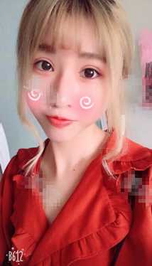 双眼皮术后165天的*果图