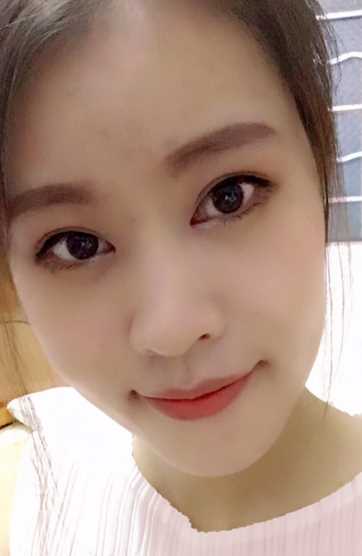 广州做的开眼角+全切双眼皮 术后*果图