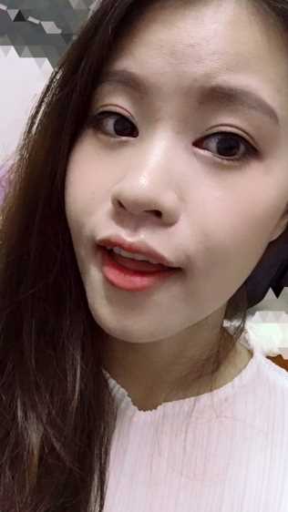 广州做的开眼角+全切双眼皮 术后*果图