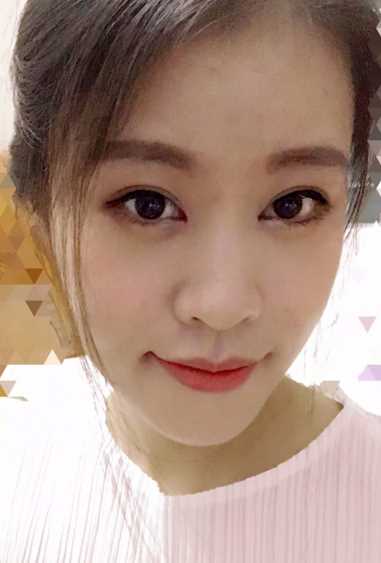 广州做的开眼角+全切双眼皮 术后*果图