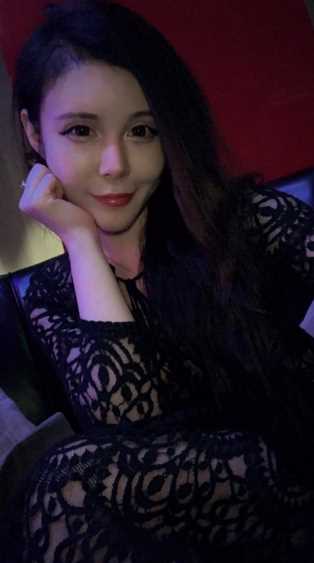 武汉做的自体脂肪填充额头术后第47天