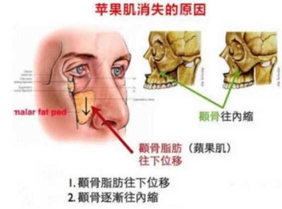 关之琳复出颜绝美？高耸的苹果肌太突兀