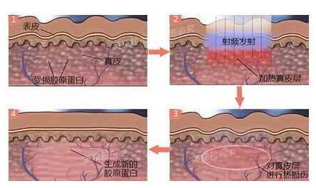 关之琳复出颜绝美?高耸的苹果肌太突兀