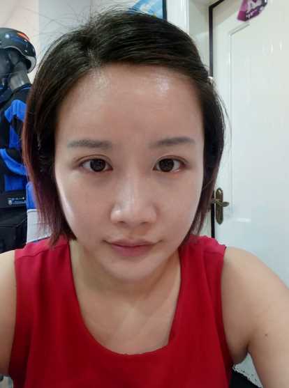 自体脂肪填充全脸术后第15天的恢复日记
