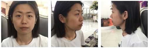 全切双眼皮 开眼角第59天