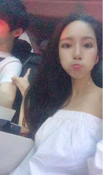 自体脂肪填充额头术后案例 自体脂肪填充额头术后案例