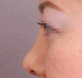 隆鼻后鼻部变歪怎么办?