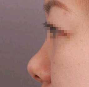 隆鼻后鼻部变歪怎么办?
