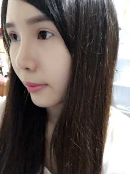 大家好,现在做的鼻翼缩小已经将近两个月了