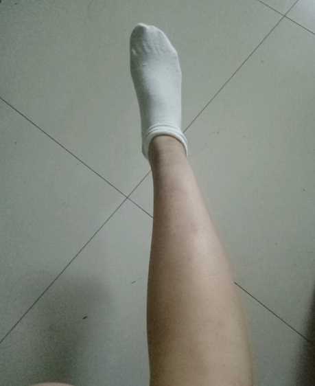 *打*瘦腿术后182天照片