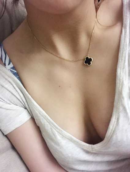 北京做的自体脂肪隆胸术后第53天 哪家好?