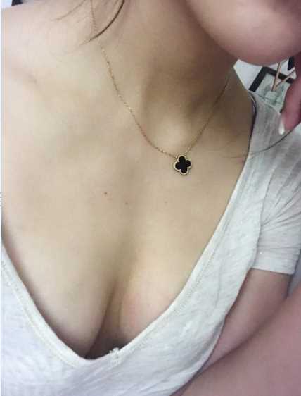 北京做的自体脂肪隆胸术后第53天 哪家好?