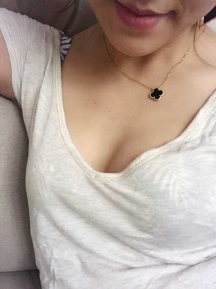 北京做的自体脂肪隆胸术后第53天 哪家好?