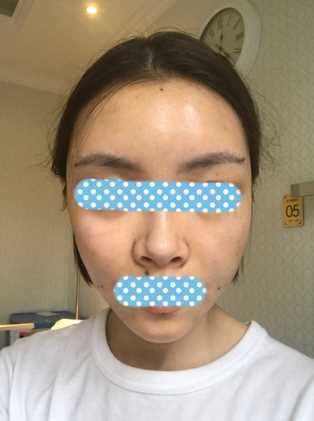 上周刚做了面部填充 可是感觉恢复很快呢!