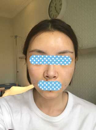 上周刚做了面部填充 可是感觉恢复很快呢!