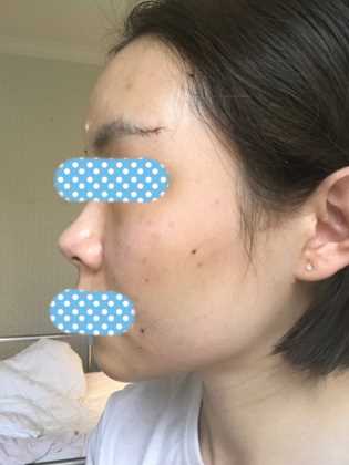 上周刚做了面部填充 可是感觉恢复很快呢!