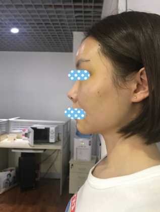 上周刚做了面部填充 可是感觉恢复很快呢!