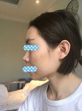 上周刚做了面部填充 可是感觉恢复很快呢!