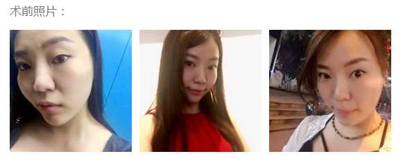 综合隆鼻术后一个半月了。
