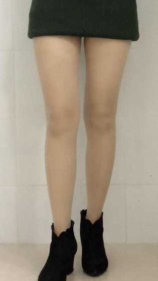 价格¥8800吸脂瘦大腿第36天