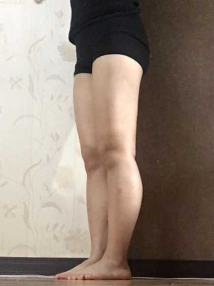 价格¥8800吸脂瘦大腿第36天