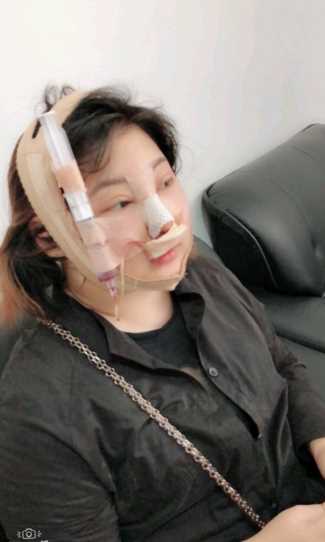 面部吸脂术后来发日记更新~嘿嘿