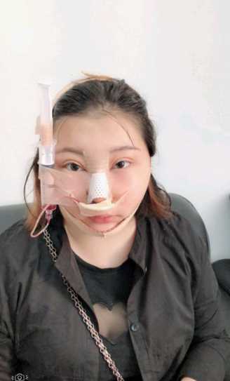 面部吸脂术后来发日记更新~嘿嘿