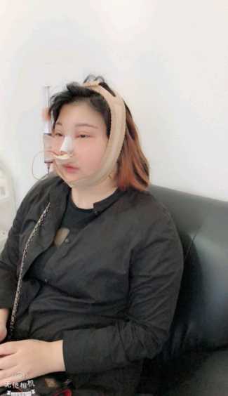 面部吸脂术后来发日记更新~嘿嘿