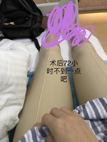 在西安悦华整形做的隆胸,也顺便把两条腿吸脂