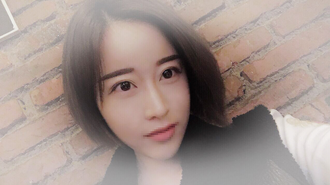 【沈阳美联致美】【切开双眼皮】