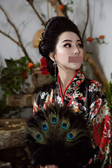 自体脂肪全脸填充术后第32天