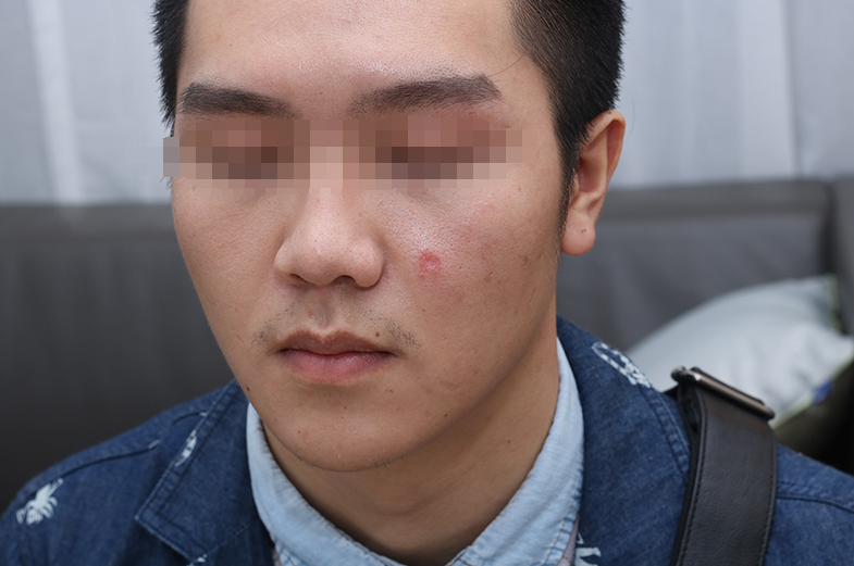 北京八大处整形科注射祛疤术后第28天