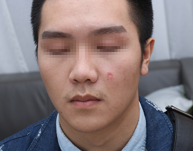北京八大处整形科注射祛疤术后第28天