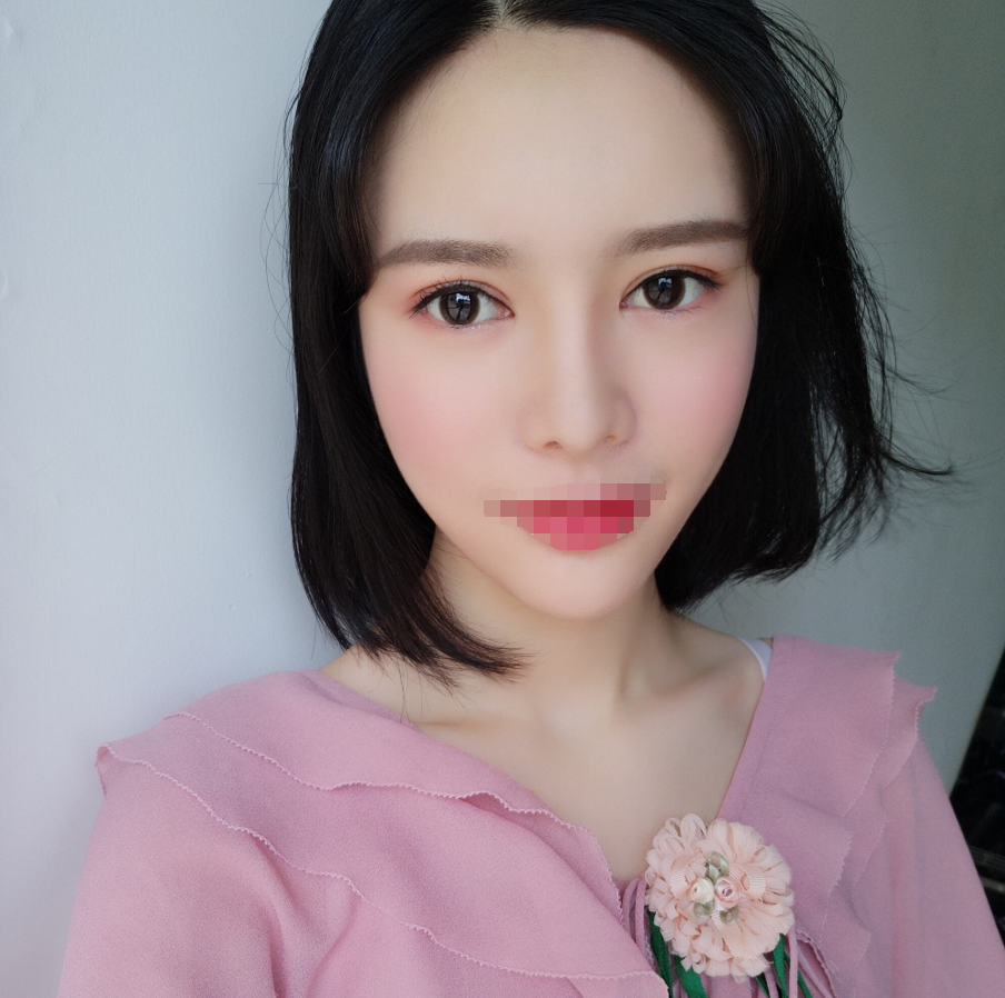 四川成都自体脂肪丰额头术后*果图