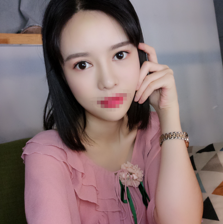 四川成都自体脂肪丰额头术后*果图