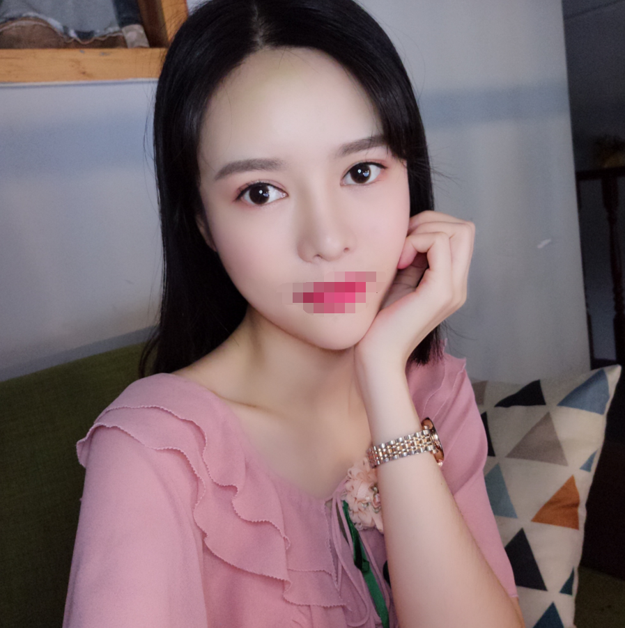 四川成都自体脂肪丰额头术后*果图