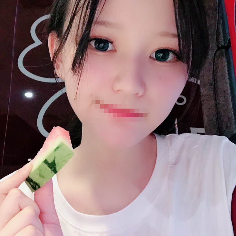 手术缩鼻翼术后第29天