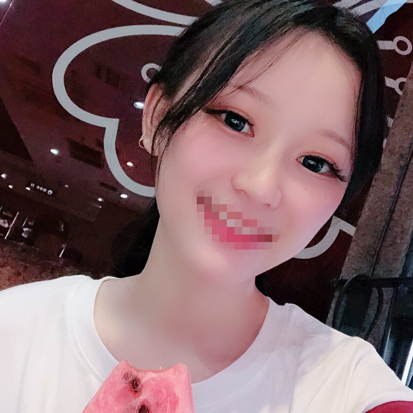 手术缩鼻翼术后第29天