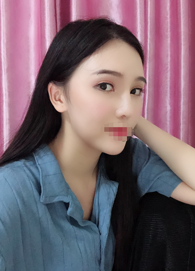 广州综合隆鼻术后两个月术后*果图